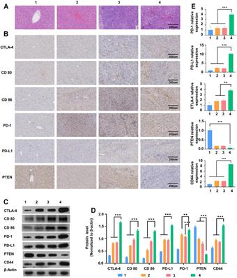 Exosome CTLA-4 Regulates PTEN/CD44 Signal Pathway in Spleen Deficiency Internal Environment to Promote Invasion and Metastasis of Hepatocellular Carcinoma